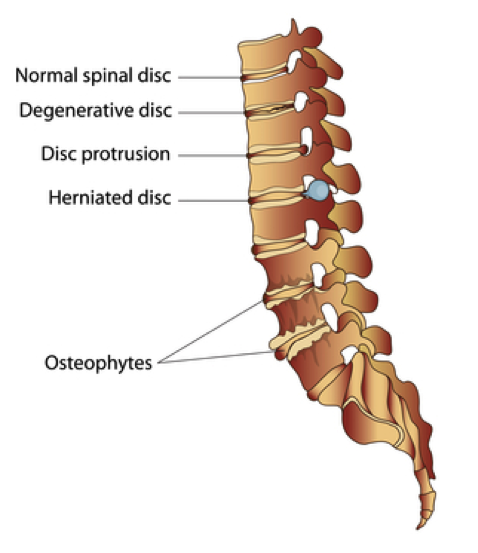 Physical Therapy for Sciatica